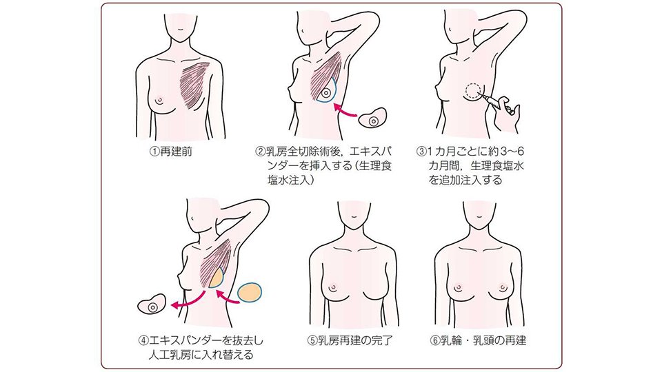 インプラントによる乳房再建（日本乳癌（がん）学会「患者さんのための乳癌診療ガイドライン」より）