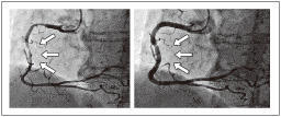 （左）冠攣縮の発作時の冠動脈。冠動脈全体が細くなり矢印部は９０％狭窄（きょうさく）となっている（右）ニトログリセリン投与後、冠動脈は本来の太さまで拡張。矢印部は軽度の動脈硬化のみになった