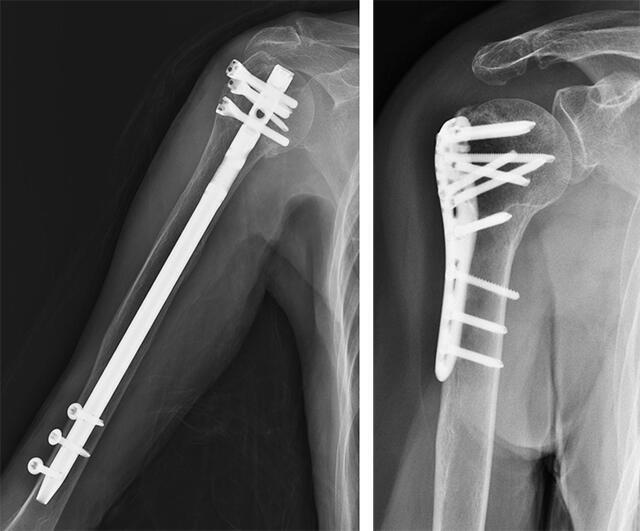 図１髄内釘による固定（左）図２プレートによる固定