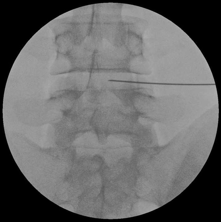 腰椎椎間板内に挿入された注射針