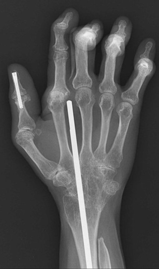手関節と母指の関節を固定したエックス線写真