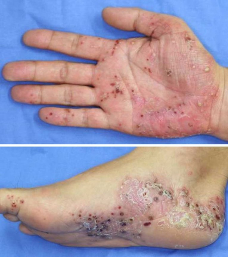 手のひらや足の裏の、掌蹠膿疱症の膿疱