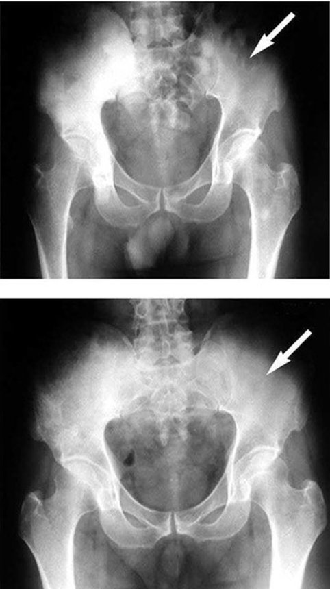 （上）レントゲンでは骨が白く写るが、矢印で示した部分は黒く「穴」が空いており、これが転移したがん（下）ラジウム治療を行うことで「穴」が消失した