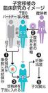 　子宮移植の臨床研究のイメージ