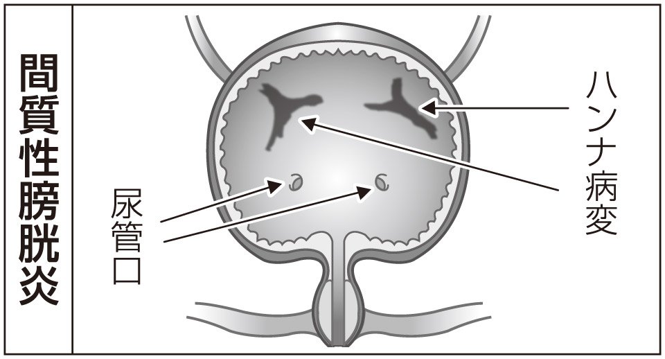 ICの症状は何ですか?