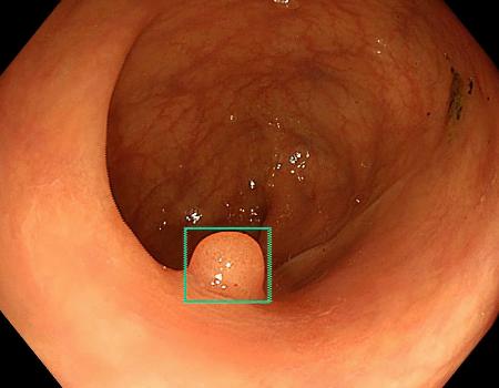 　ＡＩを使った大腸検査の補助システムの画面。ポリープと思われる部分を四角で囲って医師に示す（森悠一オスロ大教授提供）