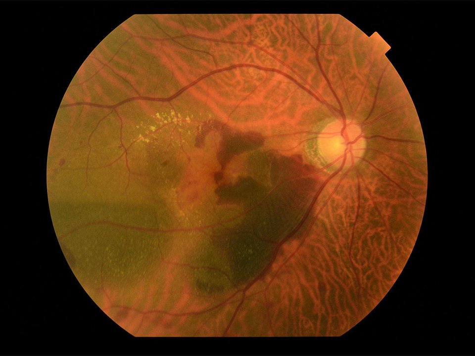滲出型加齢黄斑変性症の眼底写真。色の濃い所が病変部分