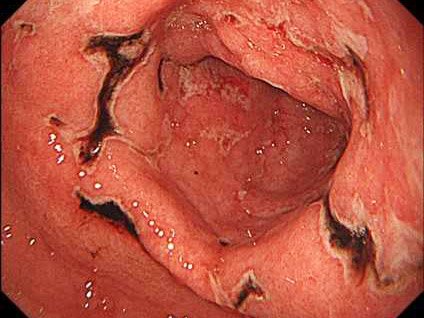 急性胃潰瘍（ＡＧＭＬ）。黒く見える部分は出血