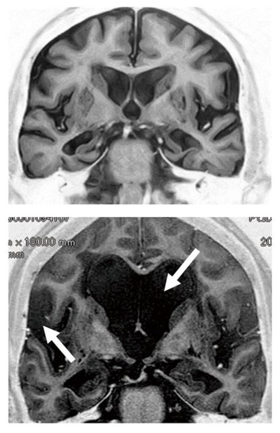特発性正常圧水頭症（右）とアルツハイマー型認知症の脳のＭＲＩ画像。一見似ているので誤診されやすいが、特発性正常圧水頭症では黒で表される脳脊髄液の停滞がある（矢印部分）