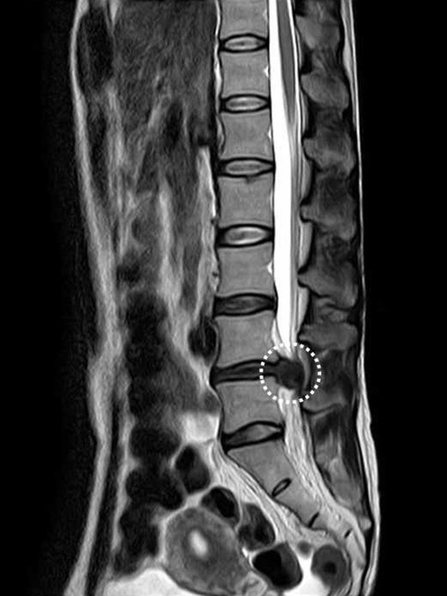 患部のＭＲＩ。破線円内が腰椎椎間板ヘルニア