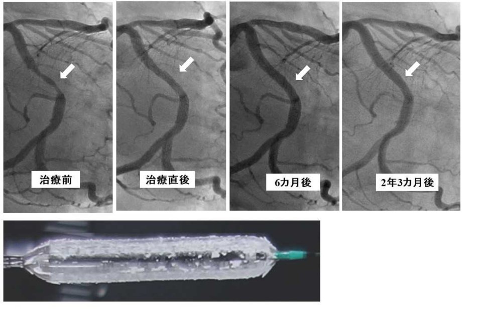 冠動脈の薬物溶出バルーン治療による晩期内腔拡大の１例。治療から６カ月後には、治療直後よりも病変部は拡大しており、２年３カ月経過しても維持されている