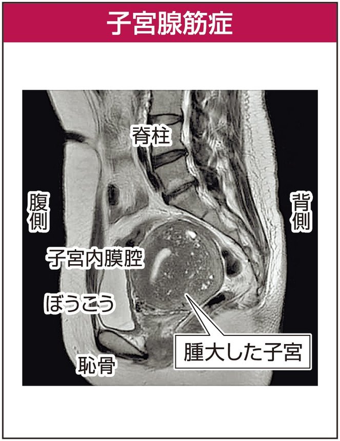 子宮腺筋症