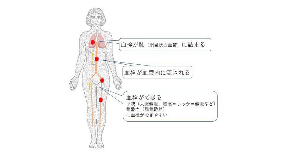 エコノミークラス症候群のメカニズム