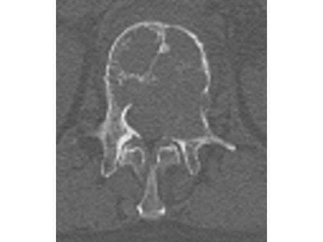 （写真１）転移した腰骨。がんによって白い骨が壊されている