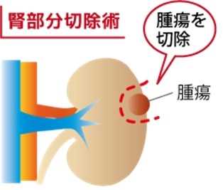 ４センチ以下の早期腎がんに対する腎部分切除術