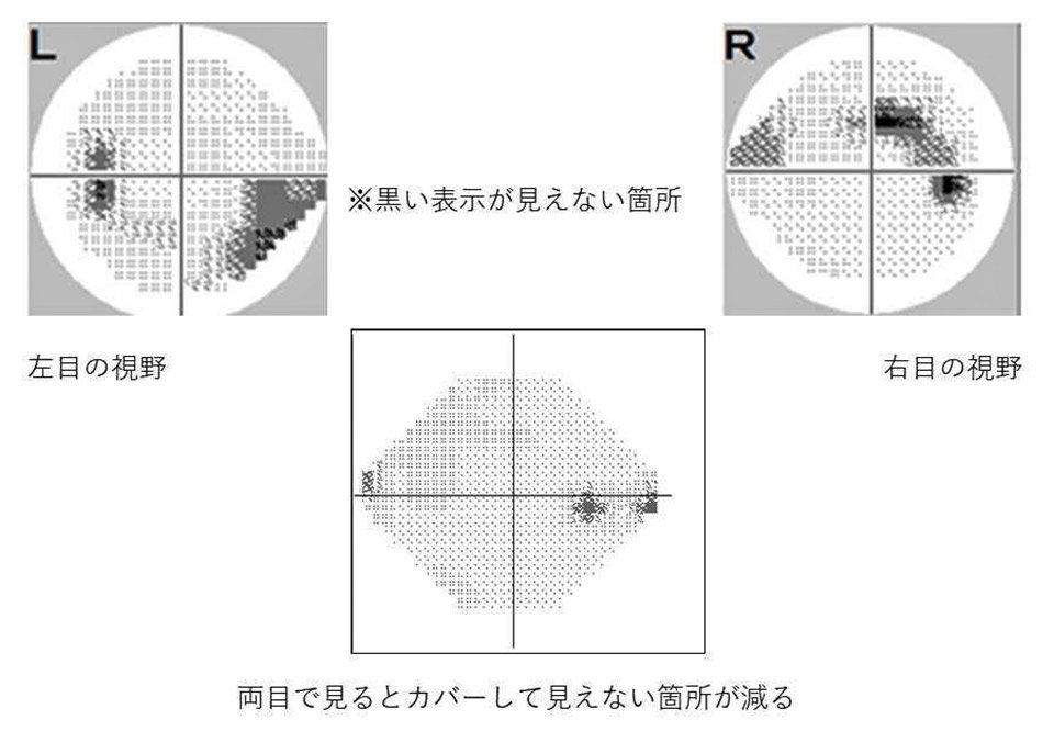 両目が初期緑内障である患者の視野検査結果の合成画像。黒い表示は見えない箇所で、Ｌが左目、Ｒが右目。両目で見た場合（下）は見えない箇所が減る