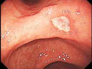 胃潰瘍。白い部分は胃粘膜が傷つき、浸出液などで覆われた状態