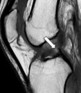 ＡＣＬ損傷膝関節のＭＲＩ（矢印が損傷部位）