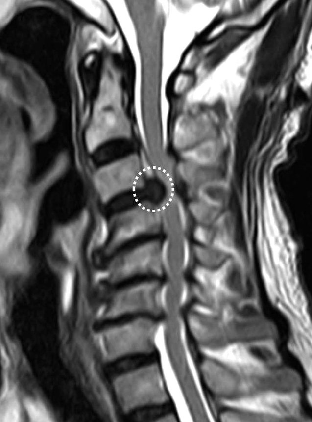 患部のＭＲＩ画像。破線円内が頸椎椎間板ヘルニア