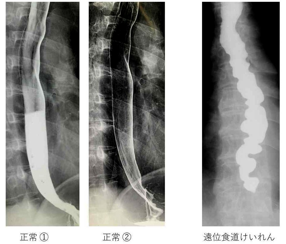 上部消化管レントゲン造影検査（食道）