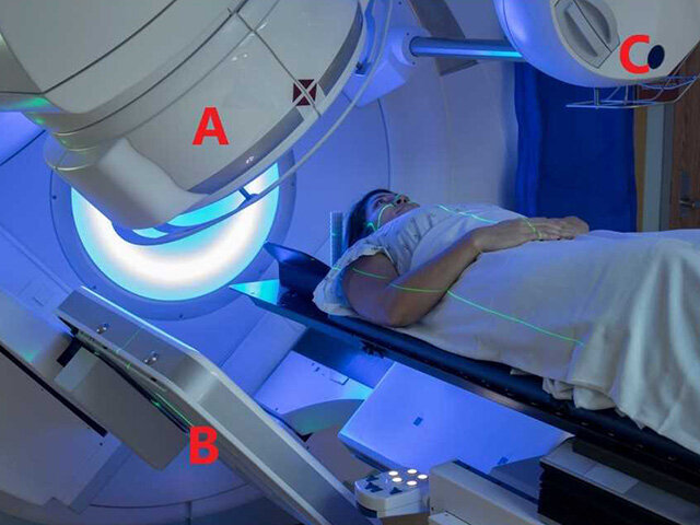 放射線治療装置では、放射線照射機器（Ａ）と、エックス線撮影した体内の骨の位置を合わせ（ＢとＣ）、がん患部に集中して照射する