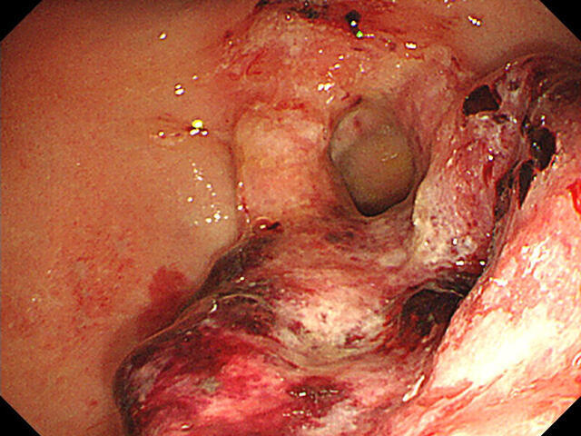 画像１・胃がんの内視鏡画像。出血を伴った潰瘍を認める