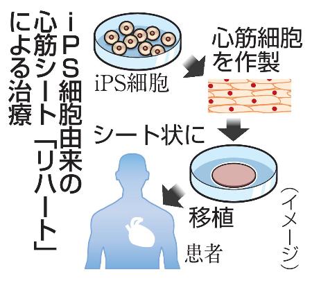 　ｉＰＳ細胞由来の心筋シート「リハート」による治療