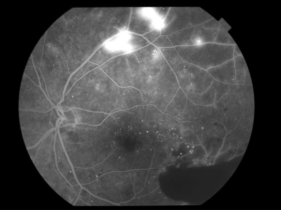 眼底造影写真。上方の白くなっている箇所が新生血管