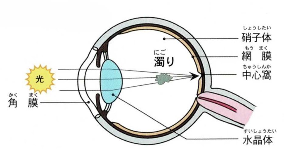 硝子体内の濁りが網膜に投影されて飛蚊症が生じる（参天製薬冊子から一部改変）