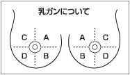 乳がんの約半数は乳房の外側上方に発生する